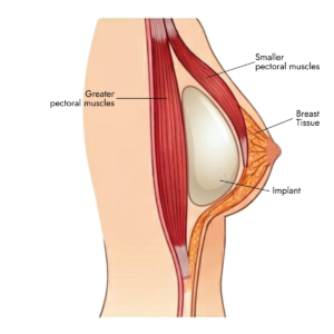 dual plane implant placement
