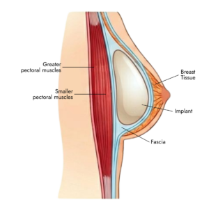 subfascial implant placement