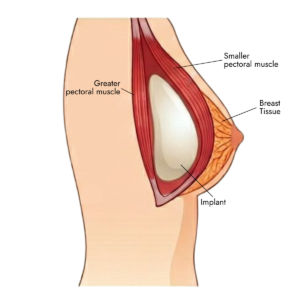 under the muscle implant placement