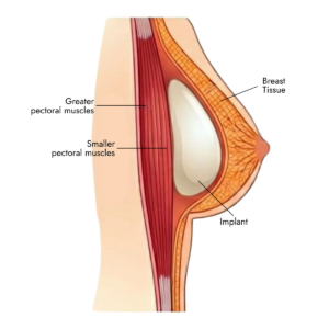 over the muscle implant placement