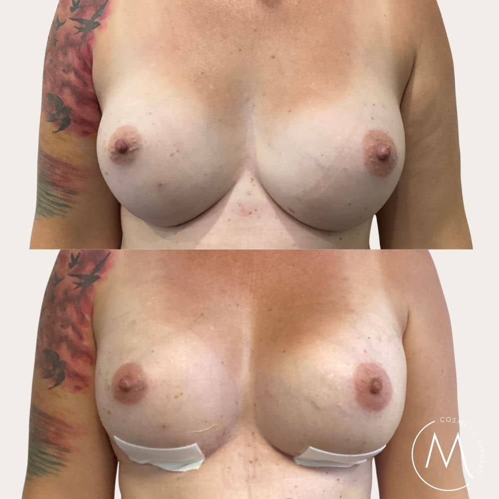 Before and after picture of breast augmentation patient