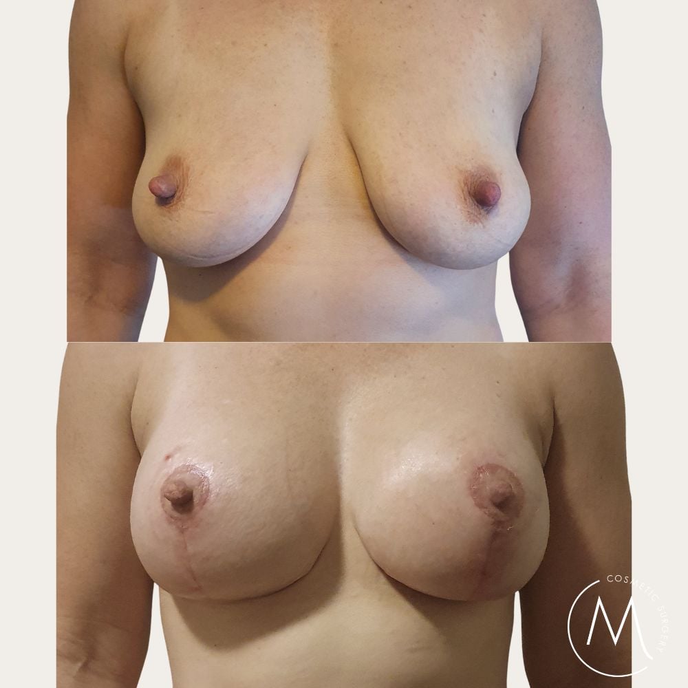 Before and after picture of breast augmentation and breast lift patient