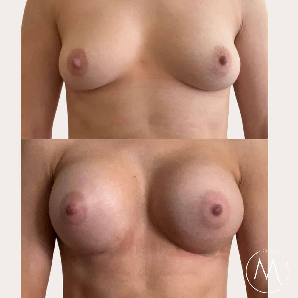 Before and after picture of breast augmentation patient