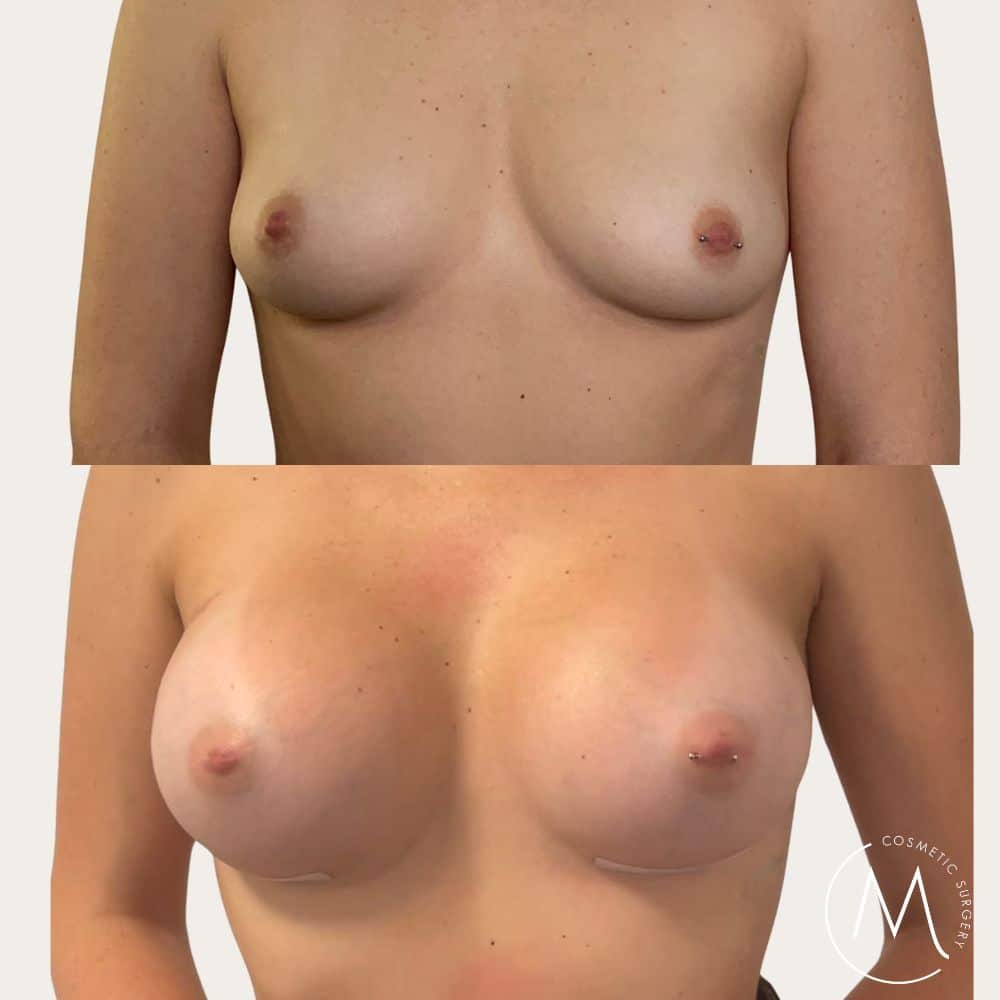 Before and after picture of breast augmentation patient