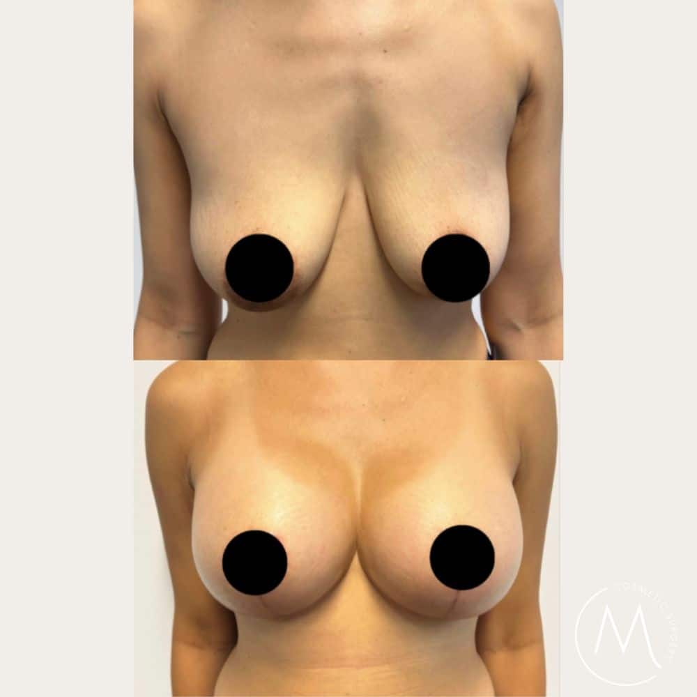 Before and after picture of Breast Lift & Augmentation patient front