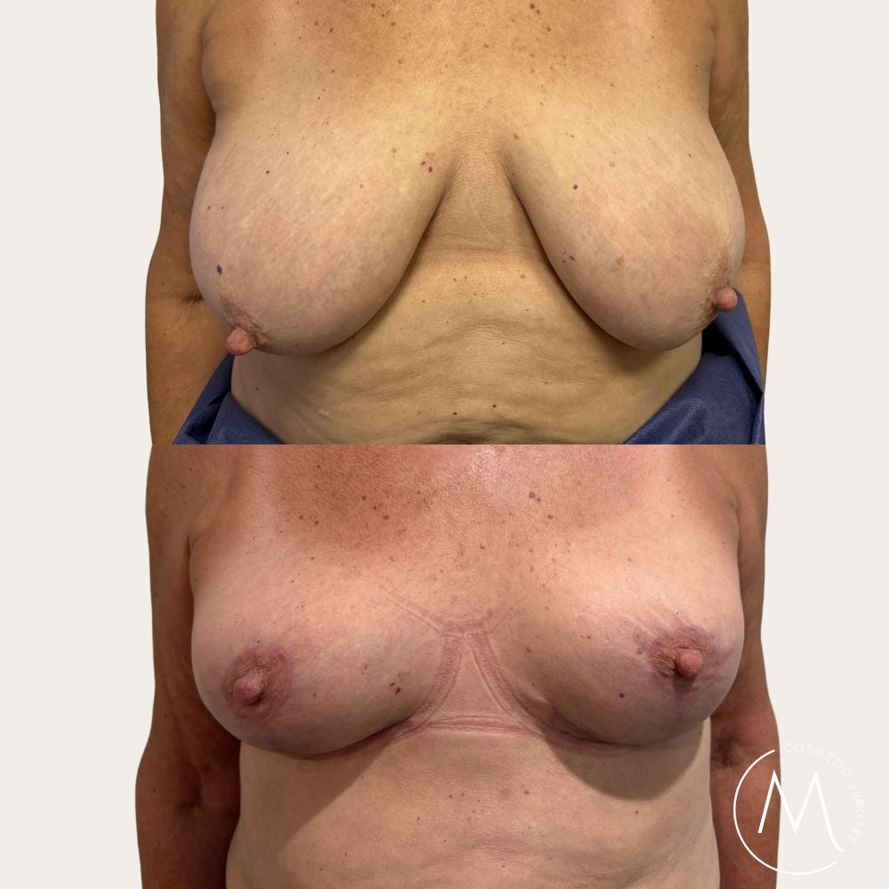 Before and after picture of breast reduction patient front