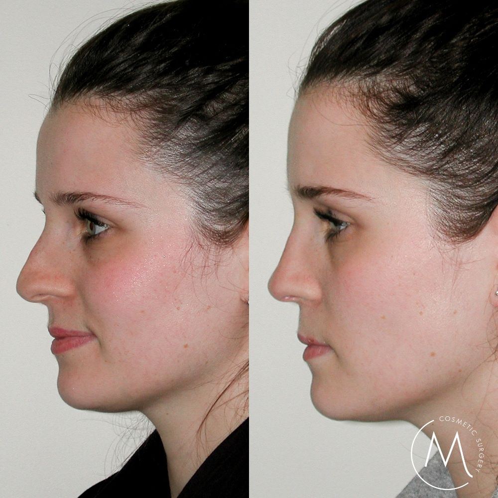 Before and after picture of rhinoplasty patient