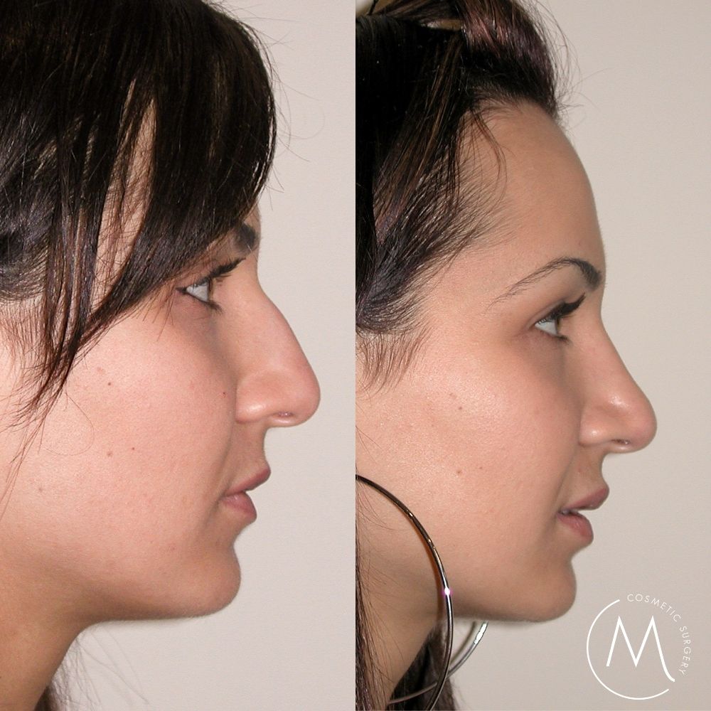 Before and after picture of rhinoplasty patient