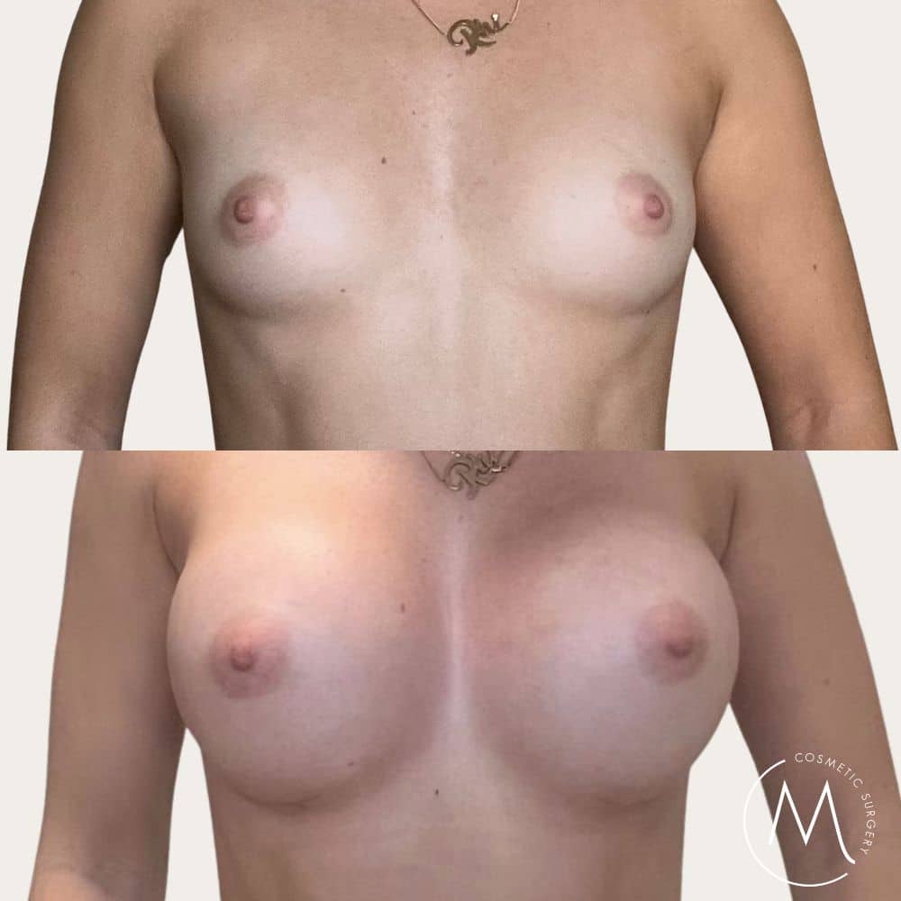 Before and after picture of breast augmentation patient