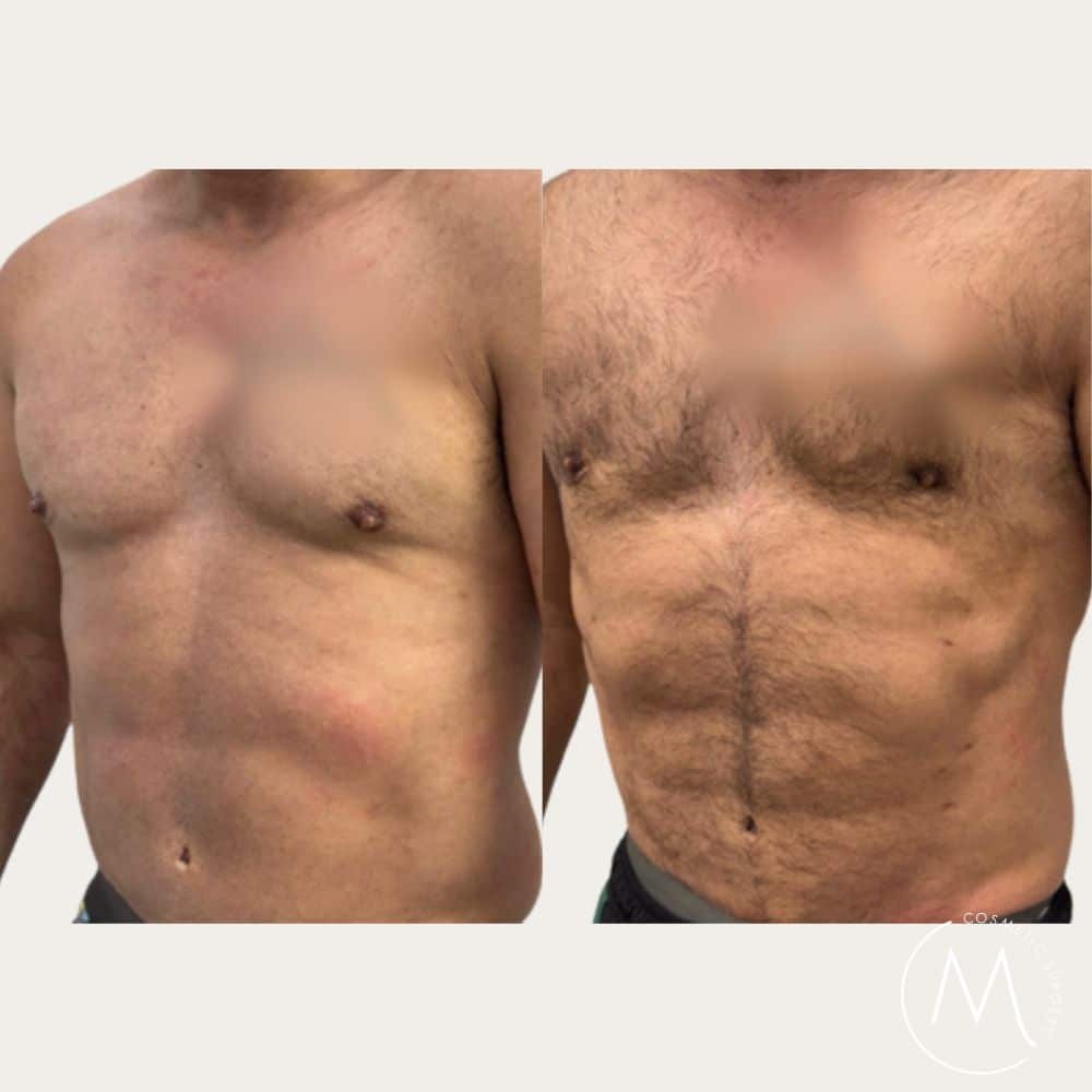 Before and after picture of liposuction patient