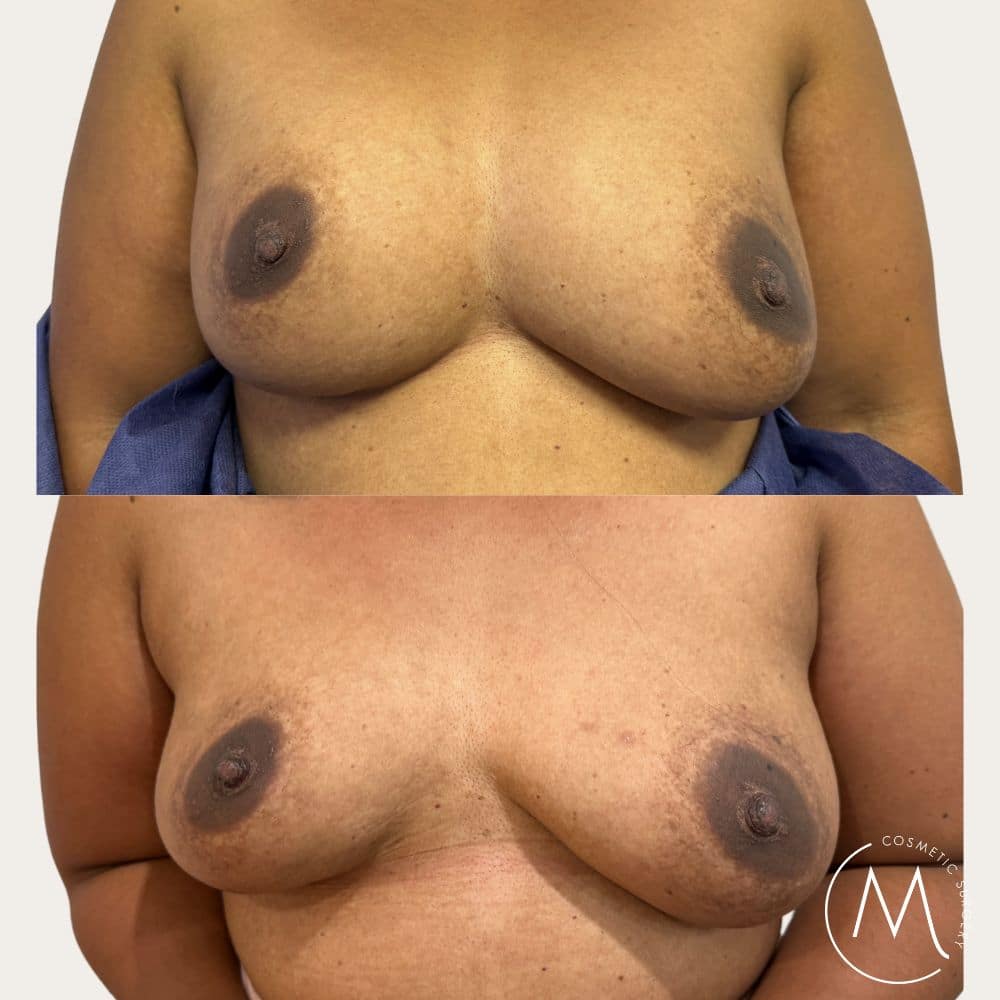 Before and after picture of Breast Implant Removal patient
