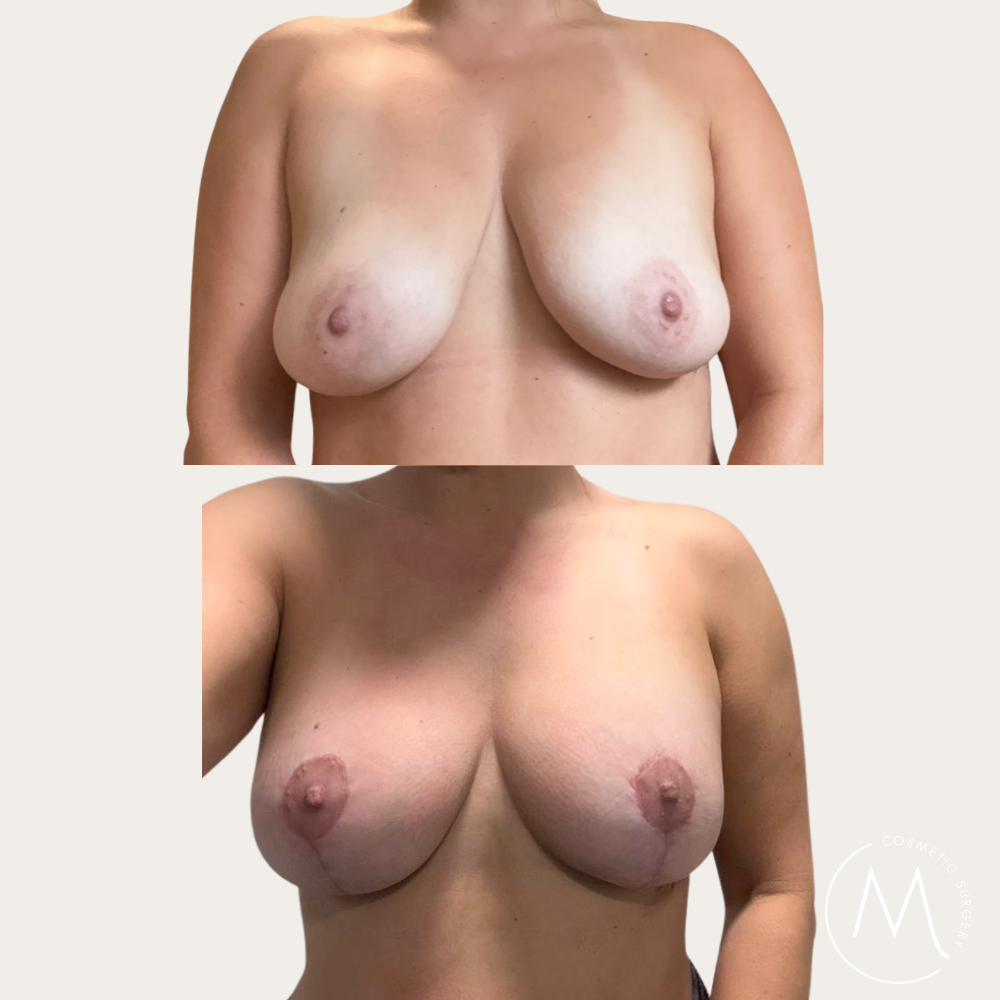 Before and after picture of breast lift and augmentation patient