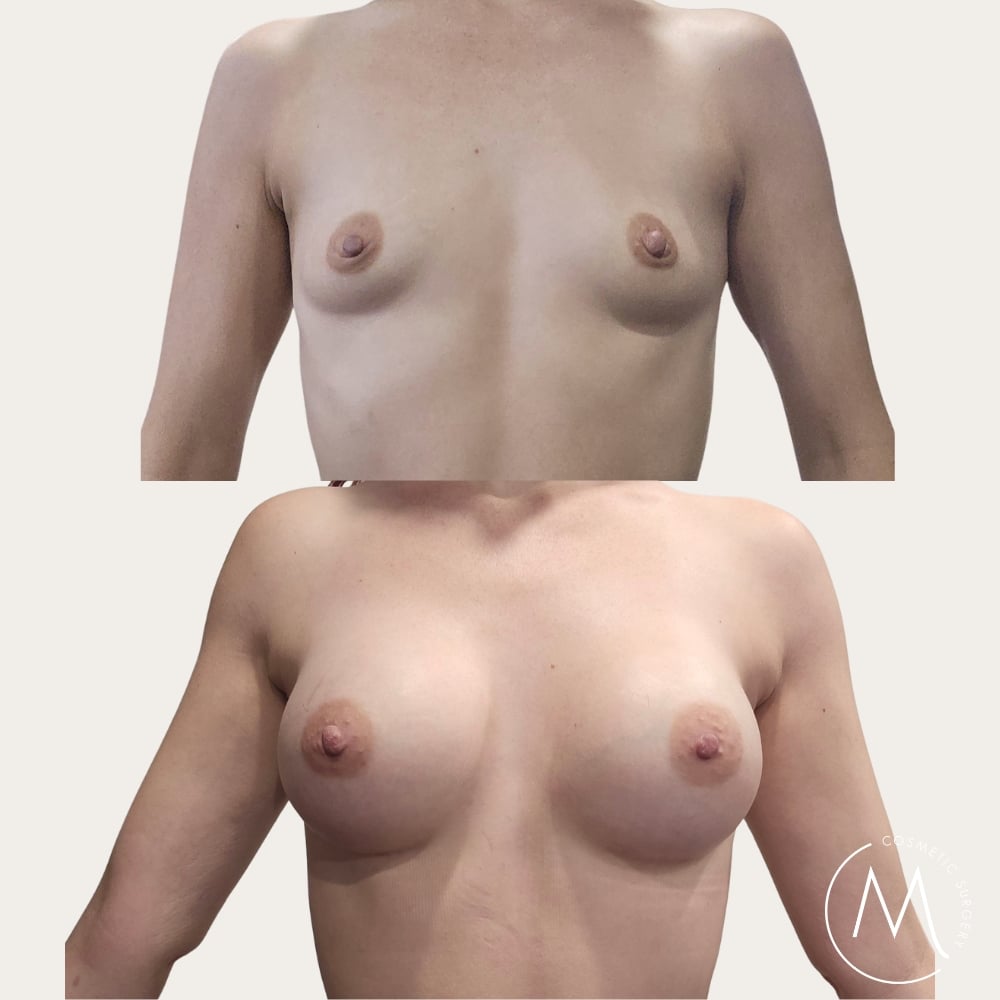 Before and after picture of breast augmentation patient