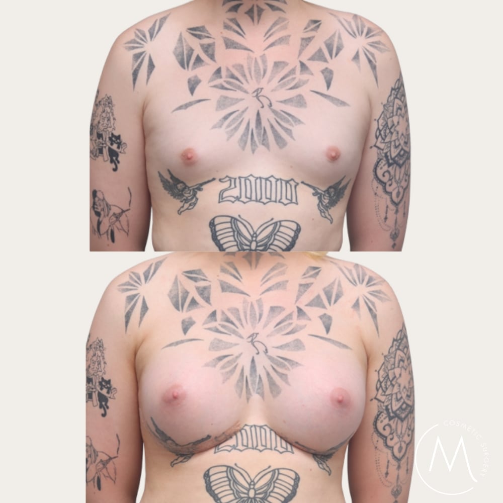 Before and after picture of breast augmentation patient
