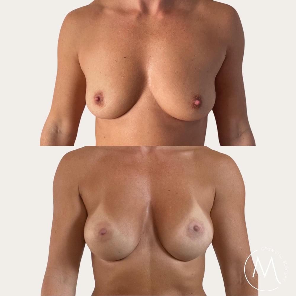 Before and after picture of breast augmentation patient