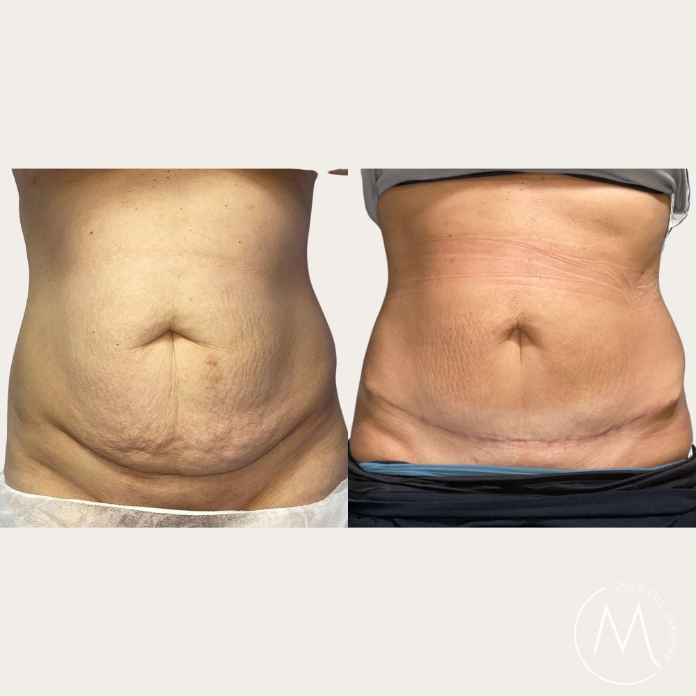 Before and after picture of Abdominoplasty patient