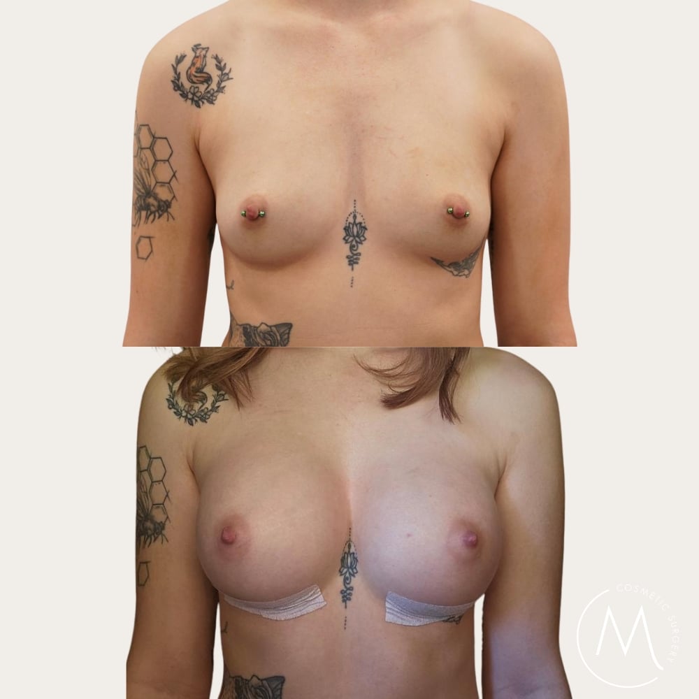 Before and after picture of breast augmentation patient