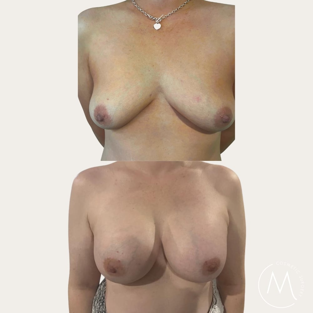 Before and after picture of breast augmentation patient