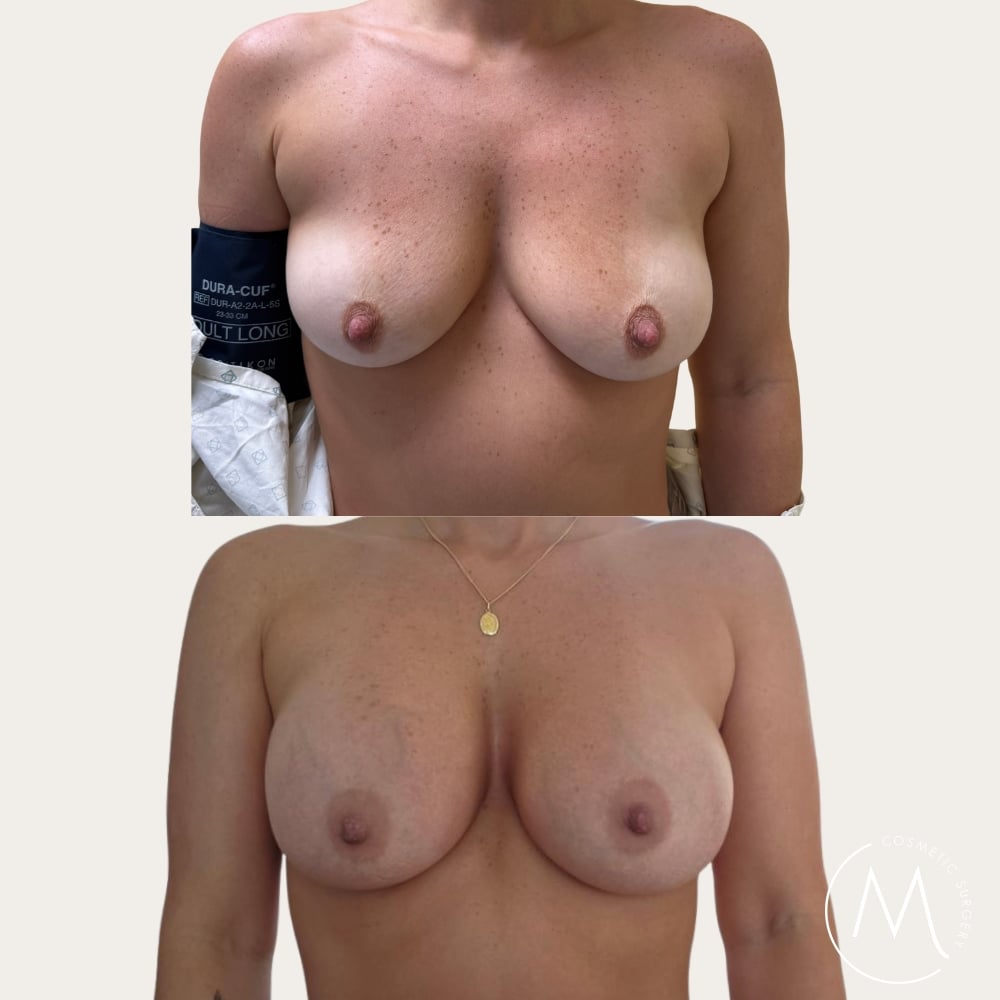 Before and after picture of breast augmentation patient