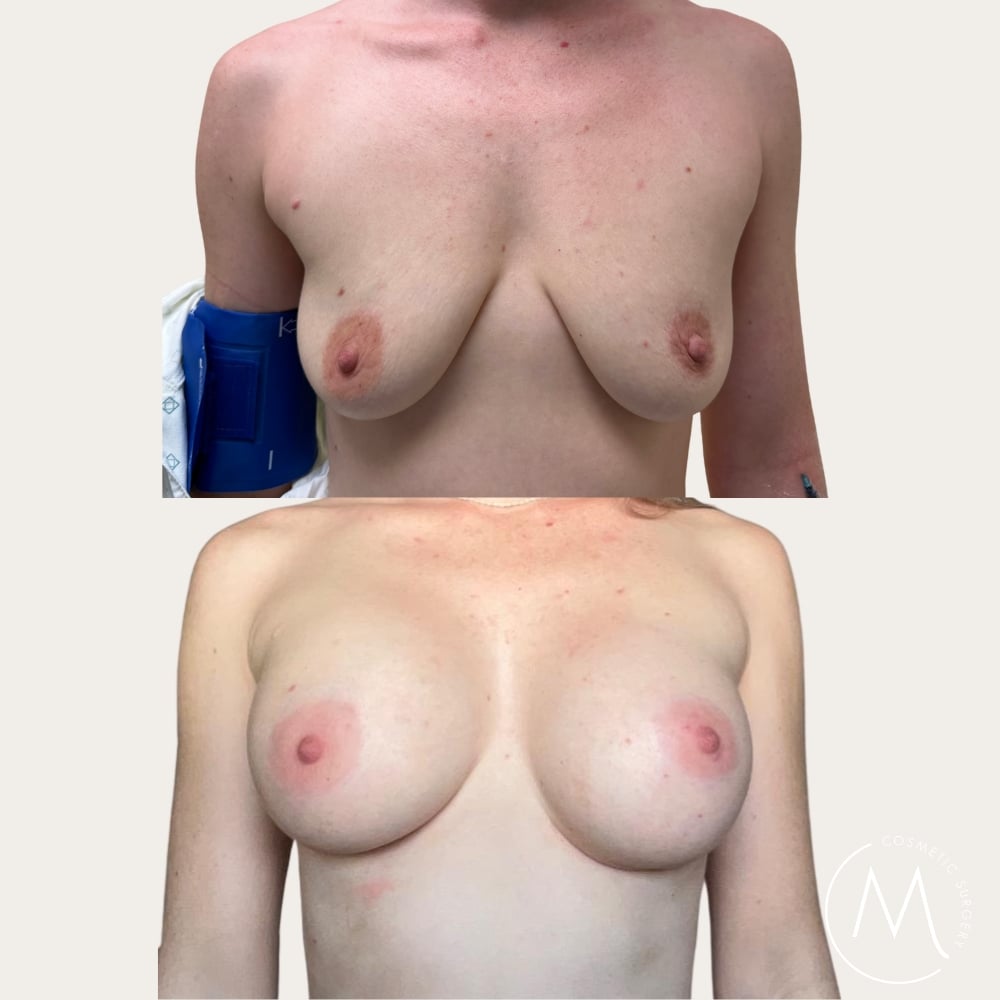 Before and after picture of breast augmentation patient