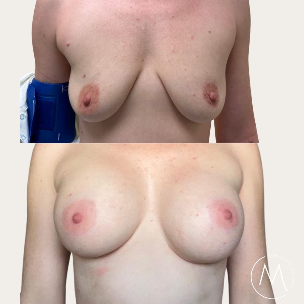 Before and after picture of breast augmentation patient