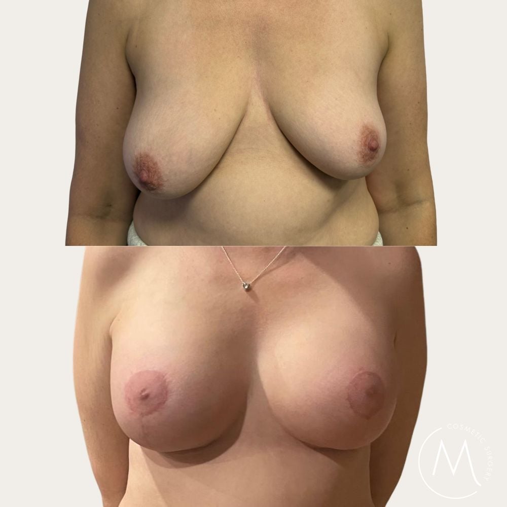 Before and after picture of Breast Lift & Augmentation patient