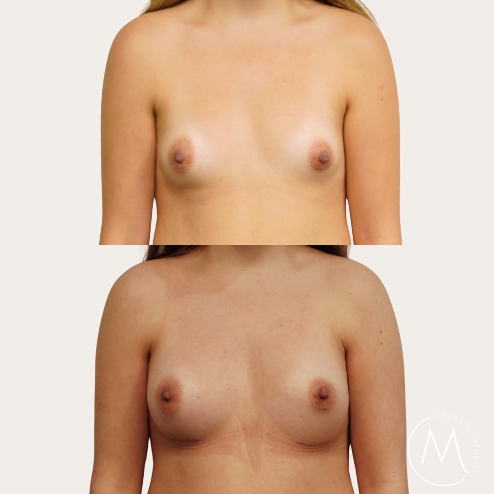 Before and after picture of breast augmentation patient
