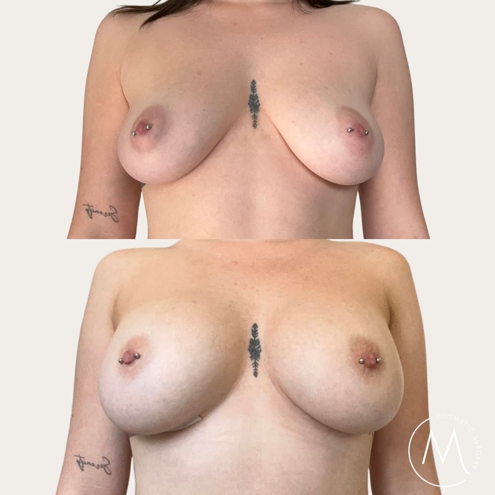 Before and after picture of breast augmentation patient