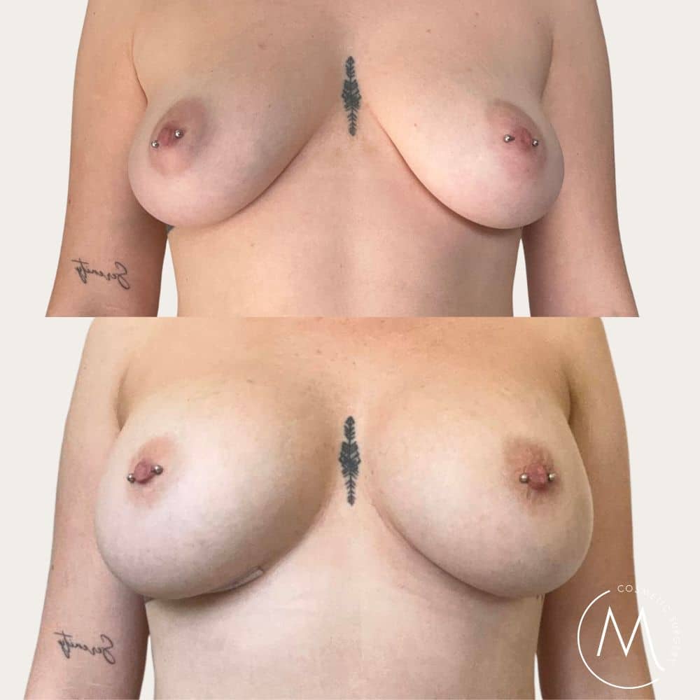Before and after picture of breast augmentation patient