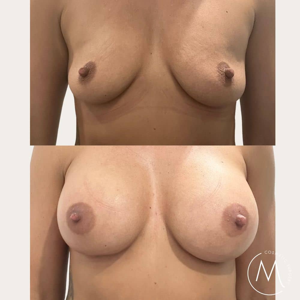 Before and after picture of breast augmentation patient