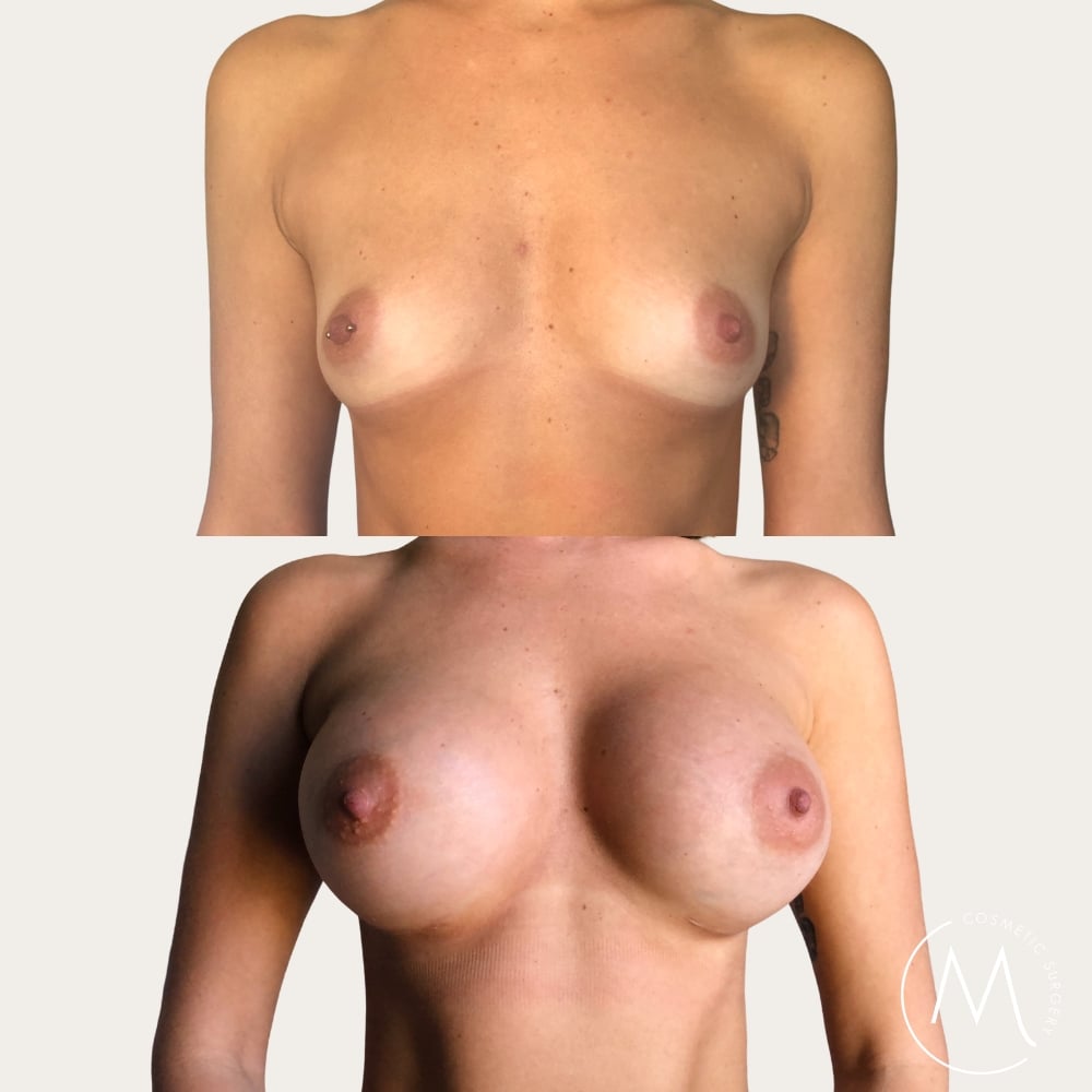 Before and after picture of breast augmentation patient