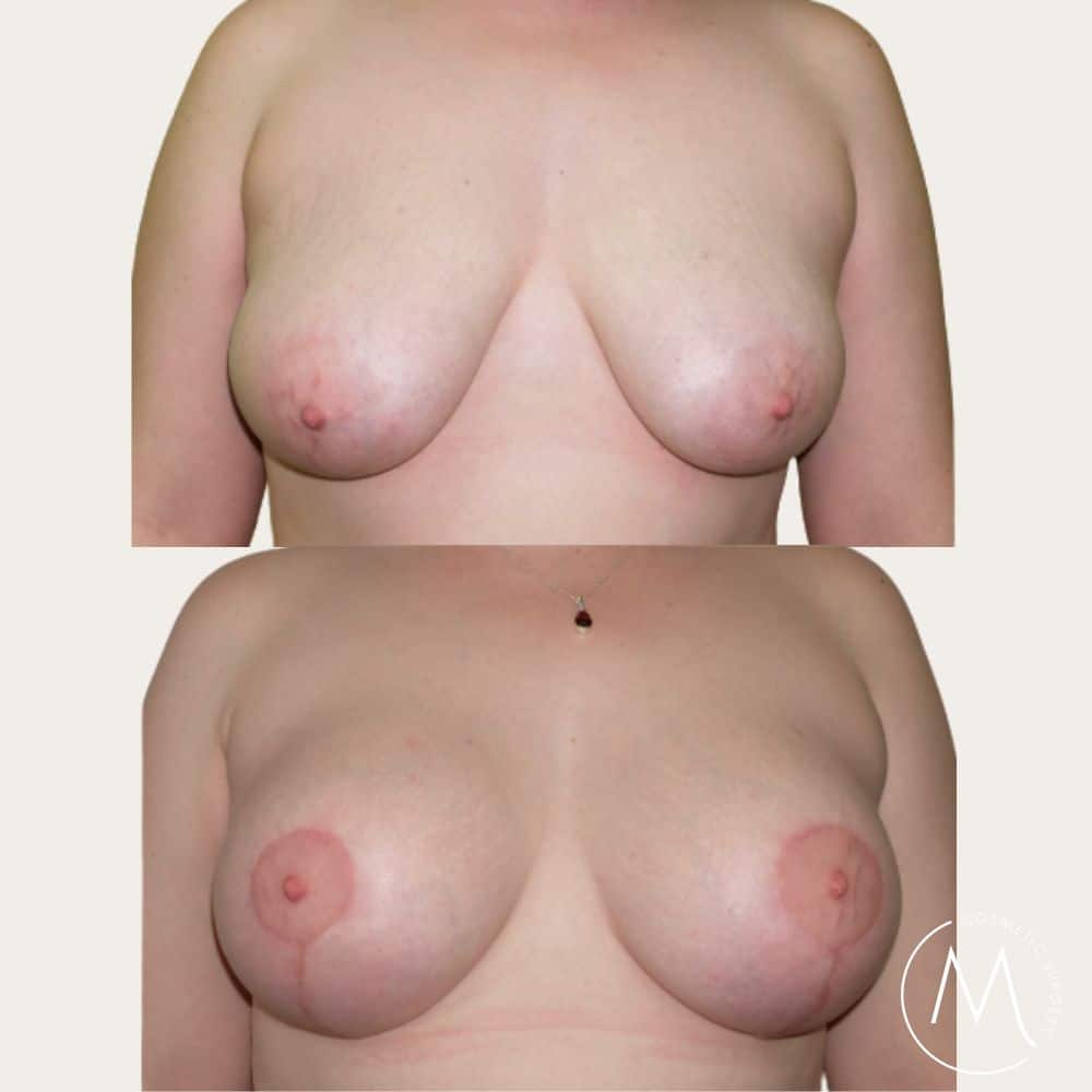 Before and after picture of Breast Lift & Augmentation patient