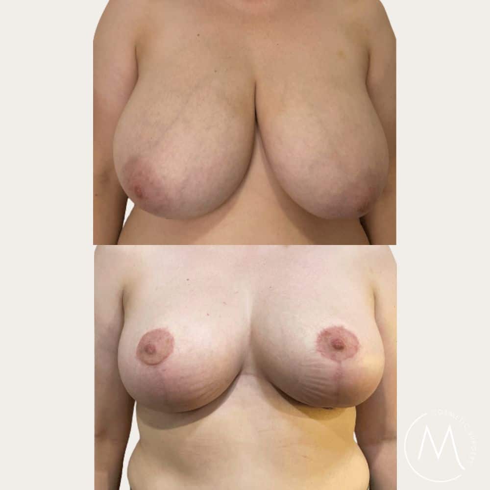 Before and after picture of breast reduction patient