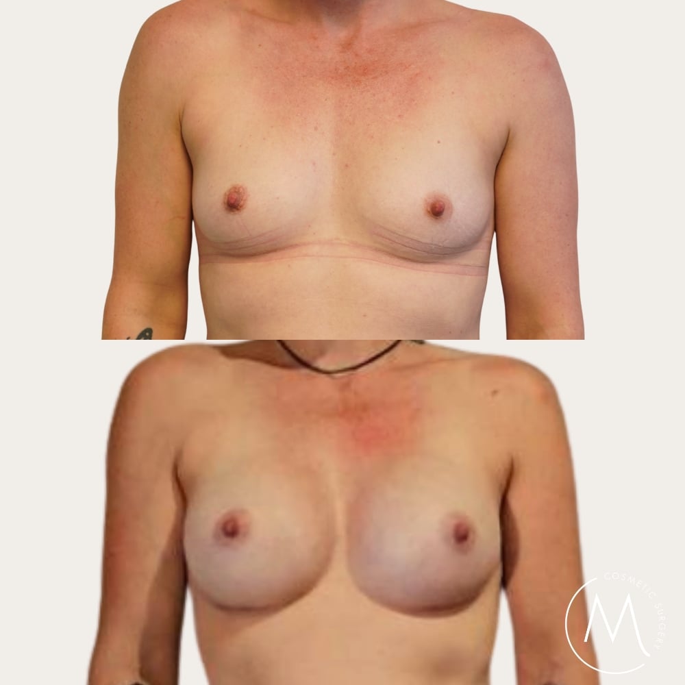 Before and after picture of breast augmentation patient