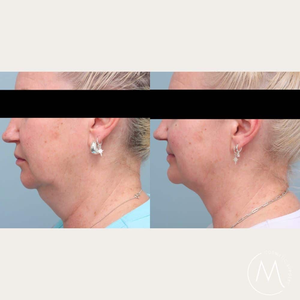 Before and after picture of Liposuction patient