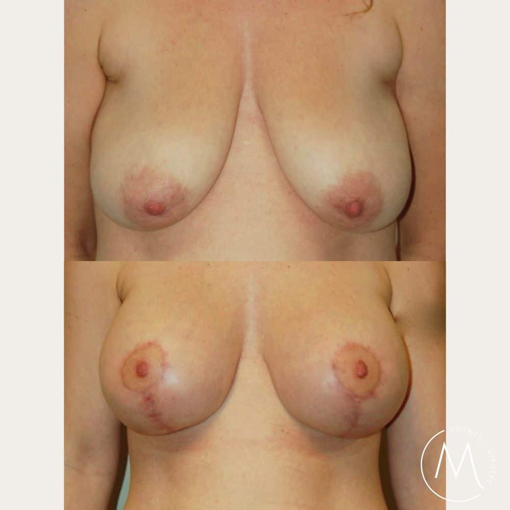 Before and after picture of breast lift and augmentation patient