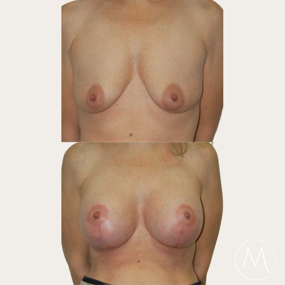 Before and after picture of breast lift and augmentation patient