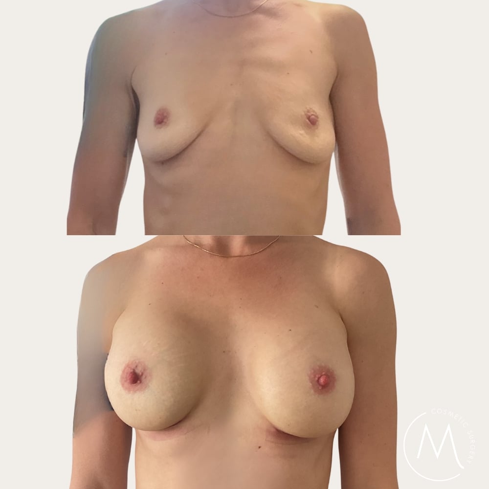 Before and after picture of breast augmentation patient