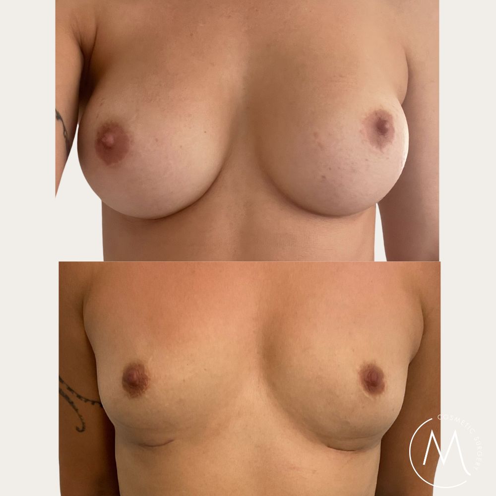 Before and after picture of Breast Implant Removal patient