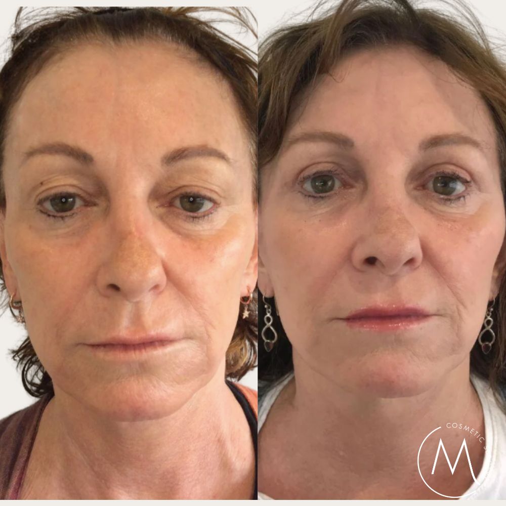 Before and after picture of Facelift + Eyelid Lift patient