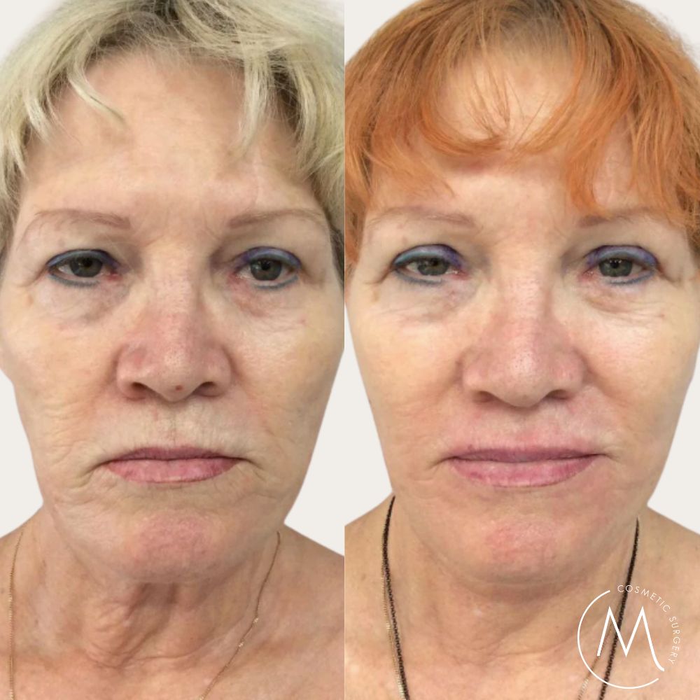 Before and after picture of Facelift + Eyelid Lift patient