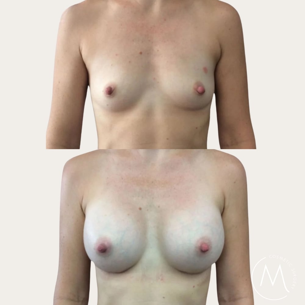 Before and after picture of breast augmentation patient