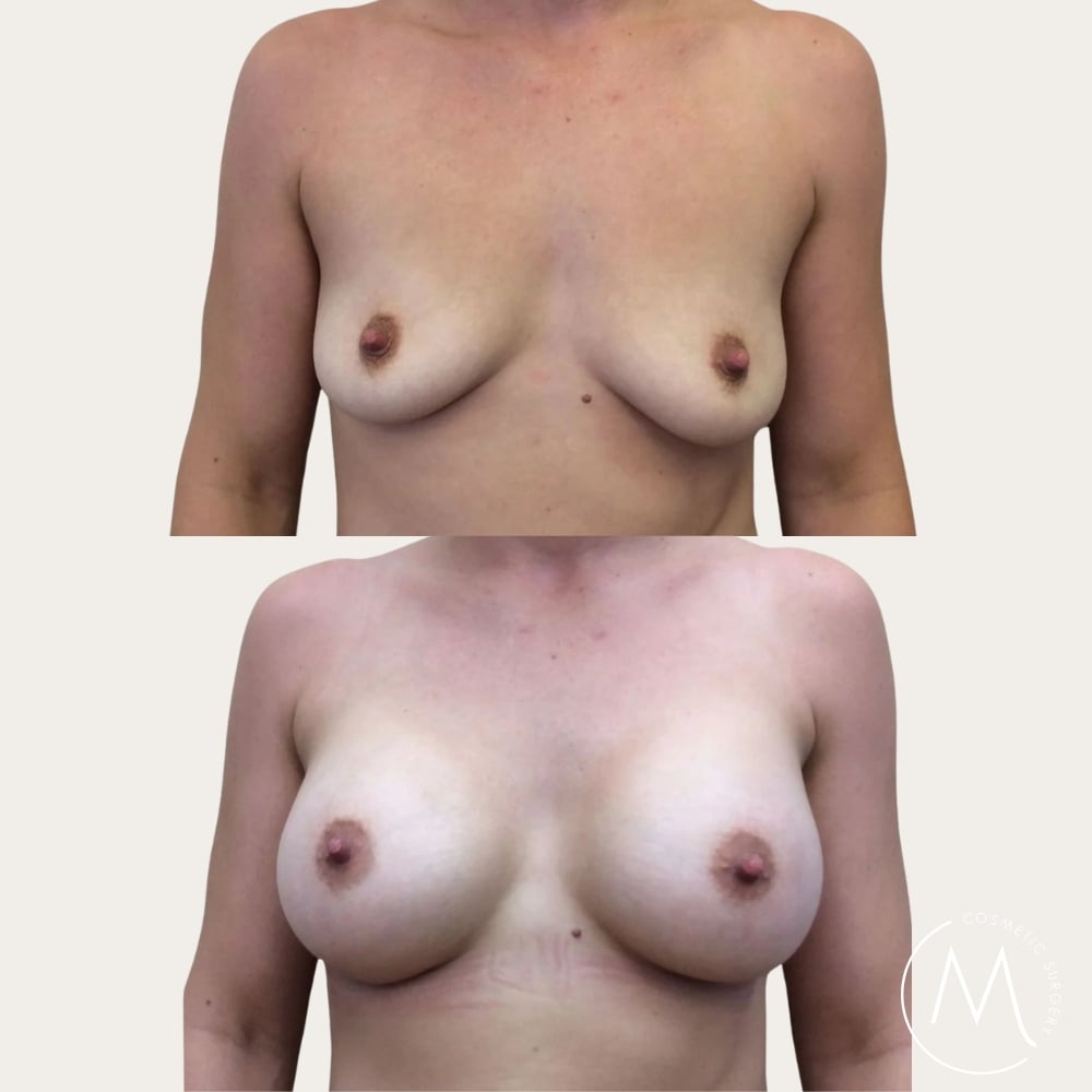 Before and after picture of breast augmentation patient