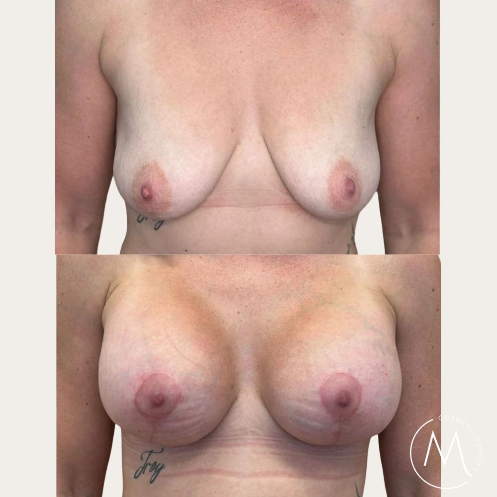 Before and after picture of Breast Lift & Augmentation patient