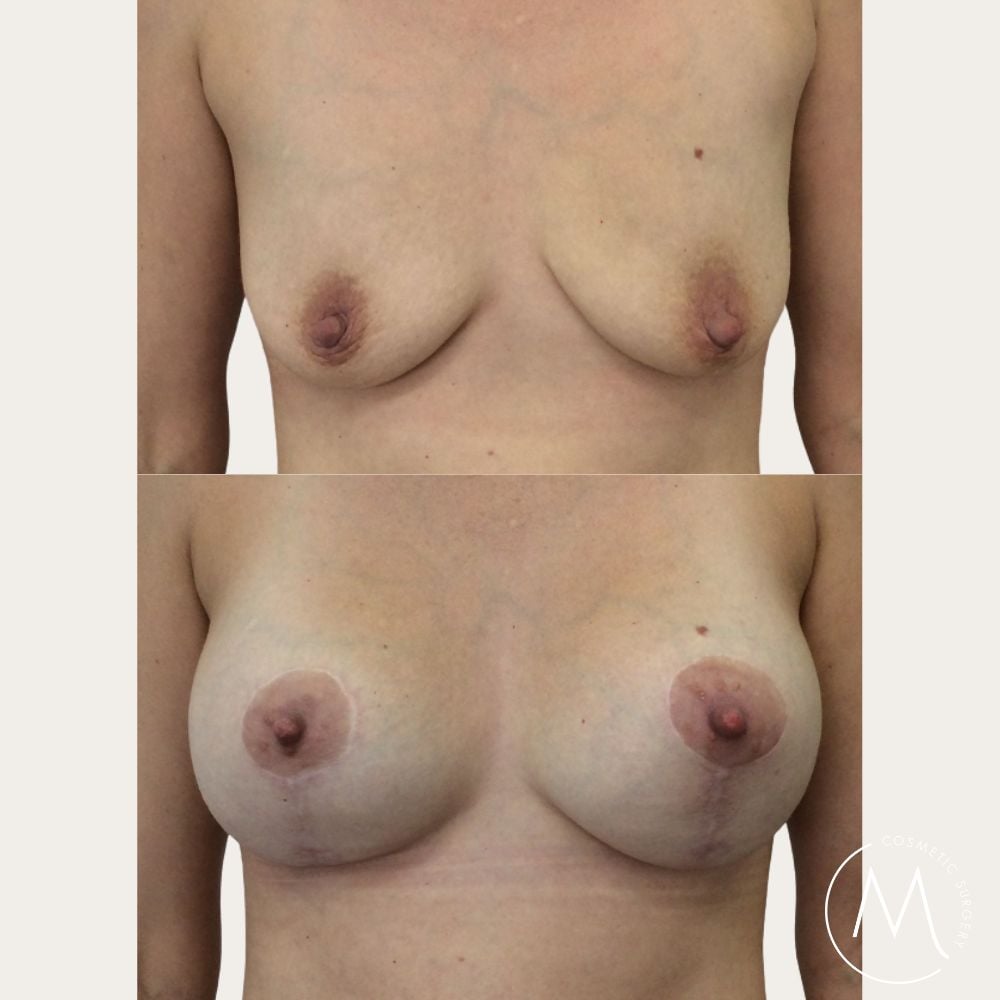Before and after picture of Breast Lift & Augmentation patient