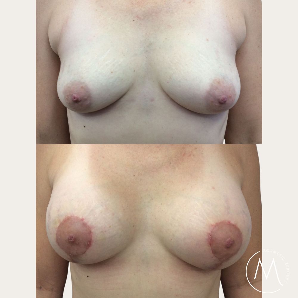 Before and after picture of Breast Lift & Augmentation patient