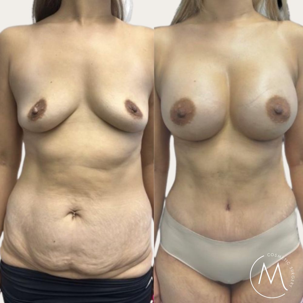 Before and after picture of Breast Augmentation and Abdominoplasty patient