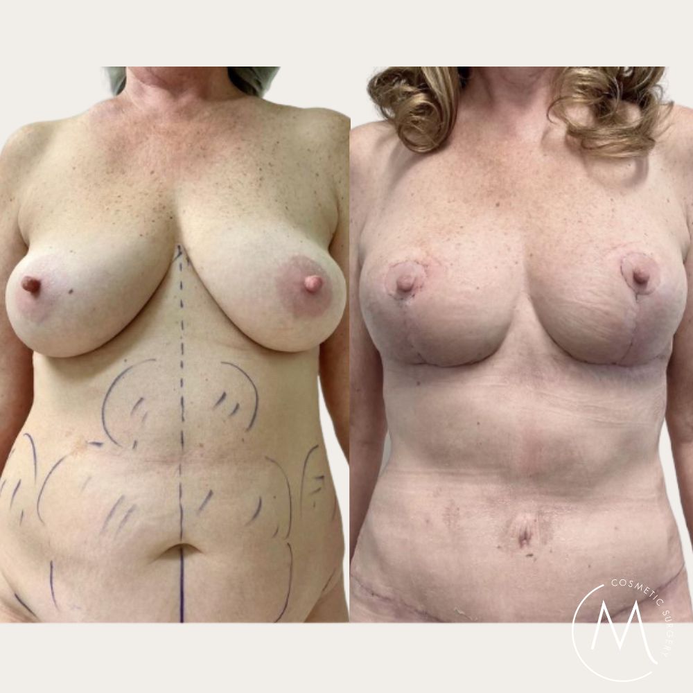Before and after picture of Breast Lift & Augmentation + Abdominoplasty patient