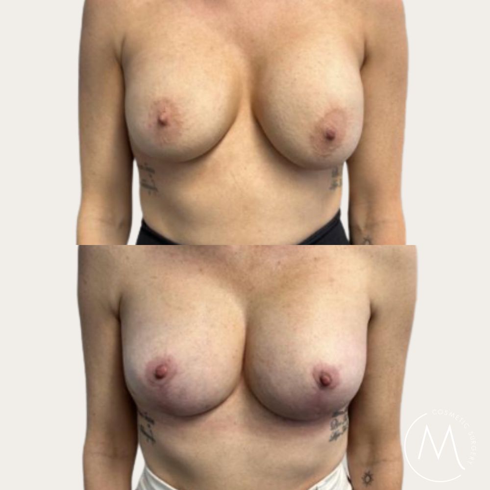 Before and after picture of Breast Revision and lift patient
