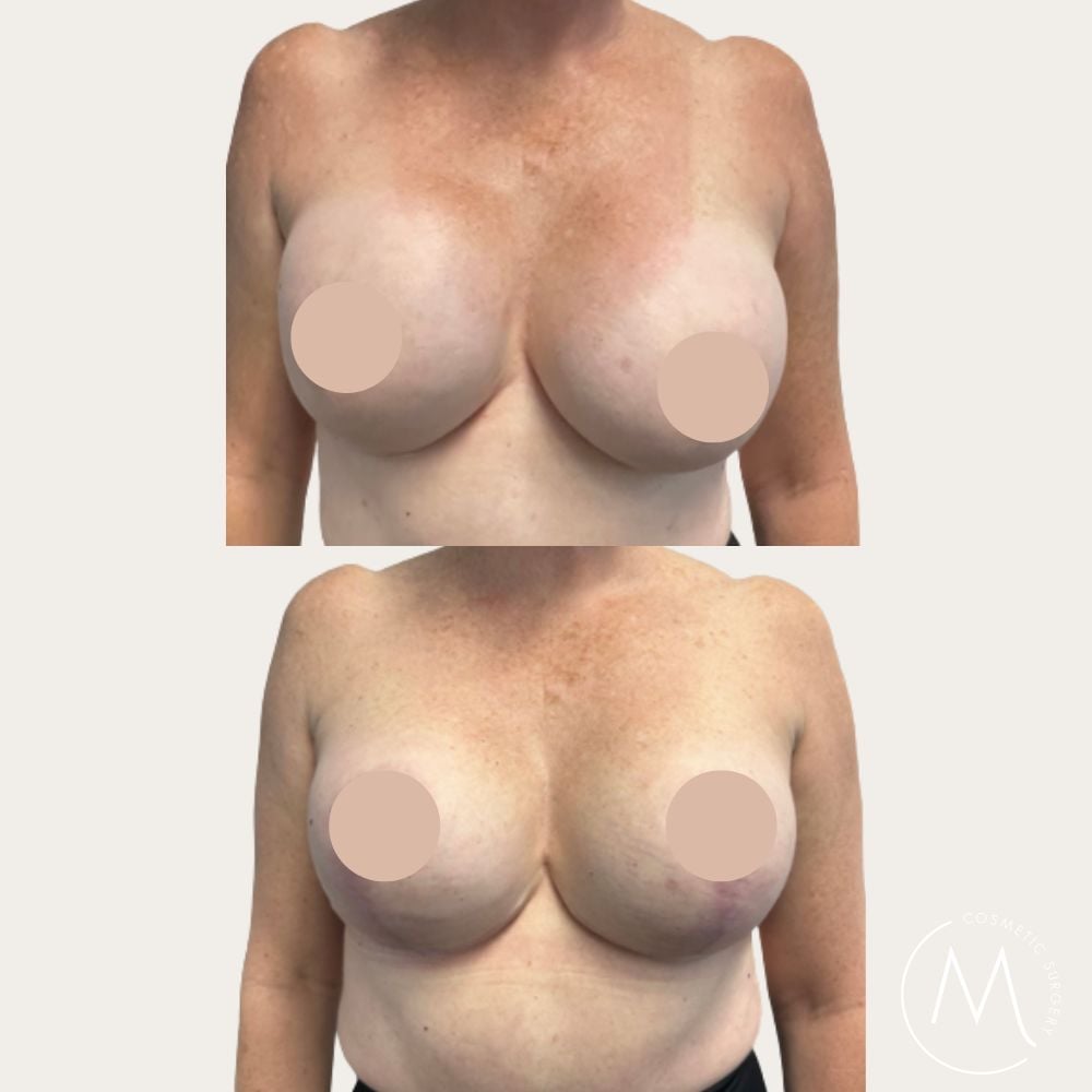 Before and after picture of breast revision + lift patient